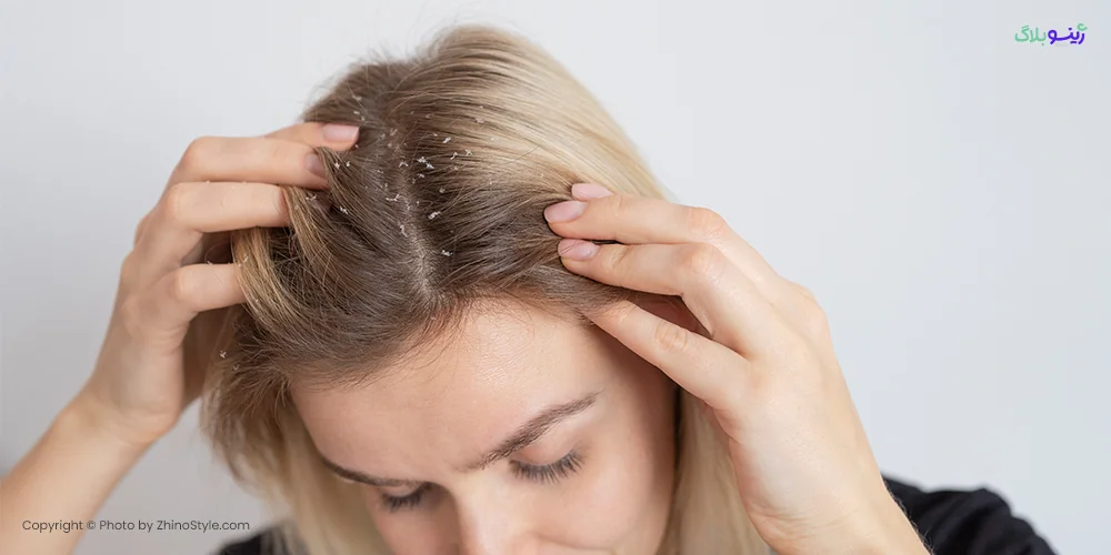 10 درمان خانگی آسان برای از بین بردن خشکی پوست سر